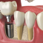 Implant dentaire : les différents matériaux utilisés